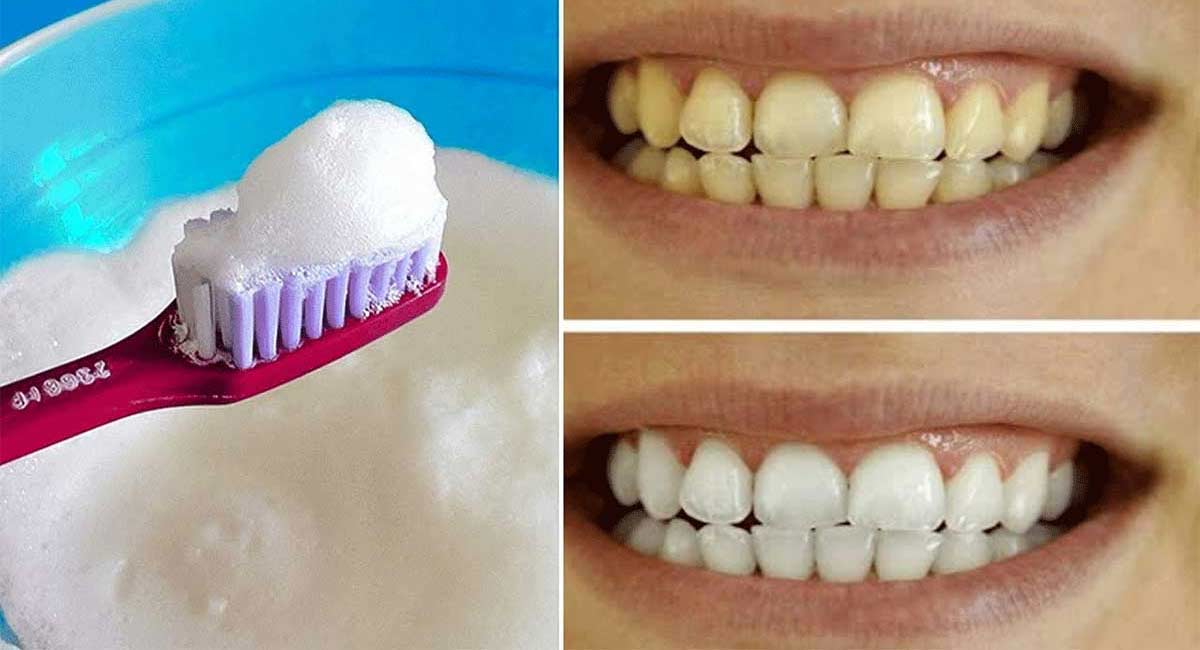 No matter how much you brush your teeth are white