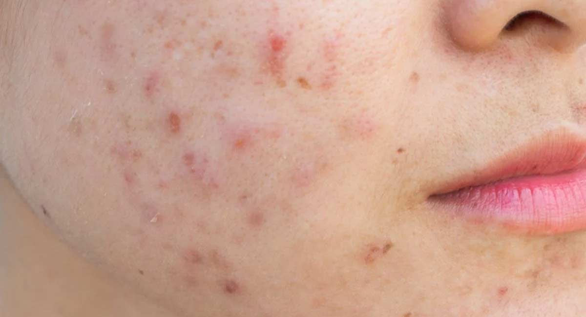 Beauty Tips The best treatment to get rid of acne scarring